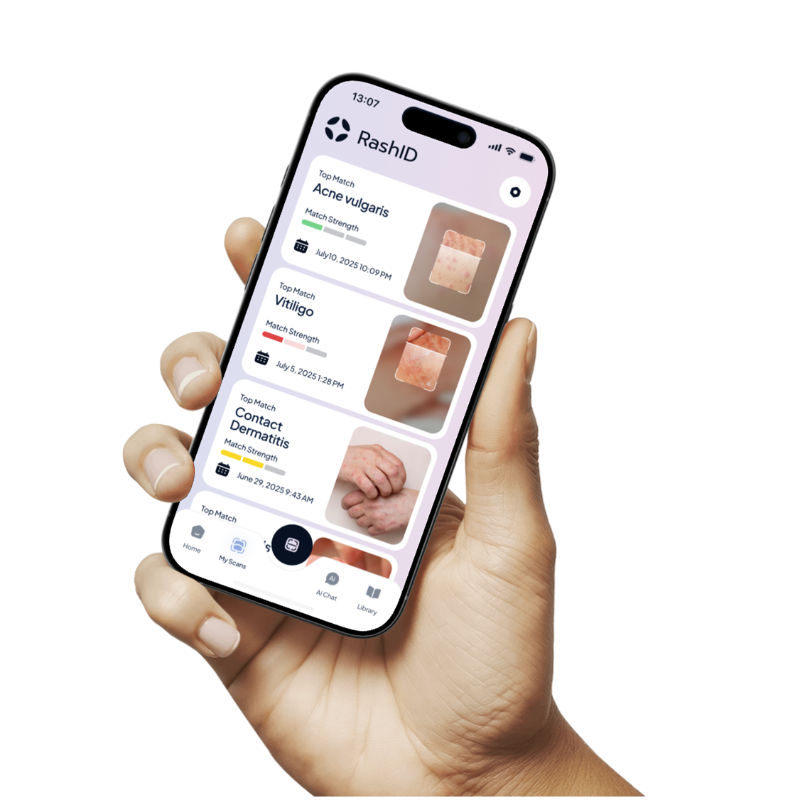 A hand with a rash is being looked at through a magnifying glass.